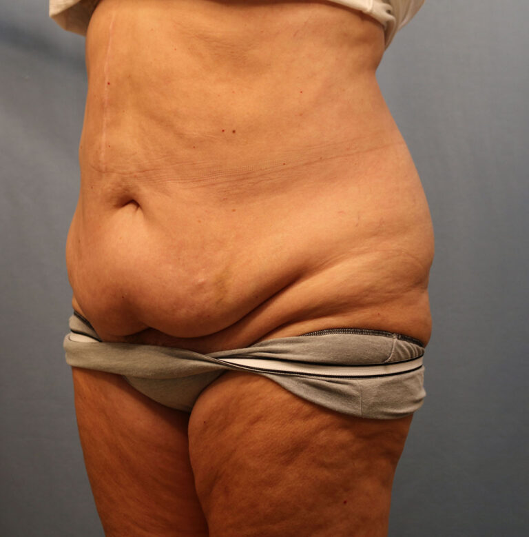 Before Image: Tummy Tuck - left-front-oblique