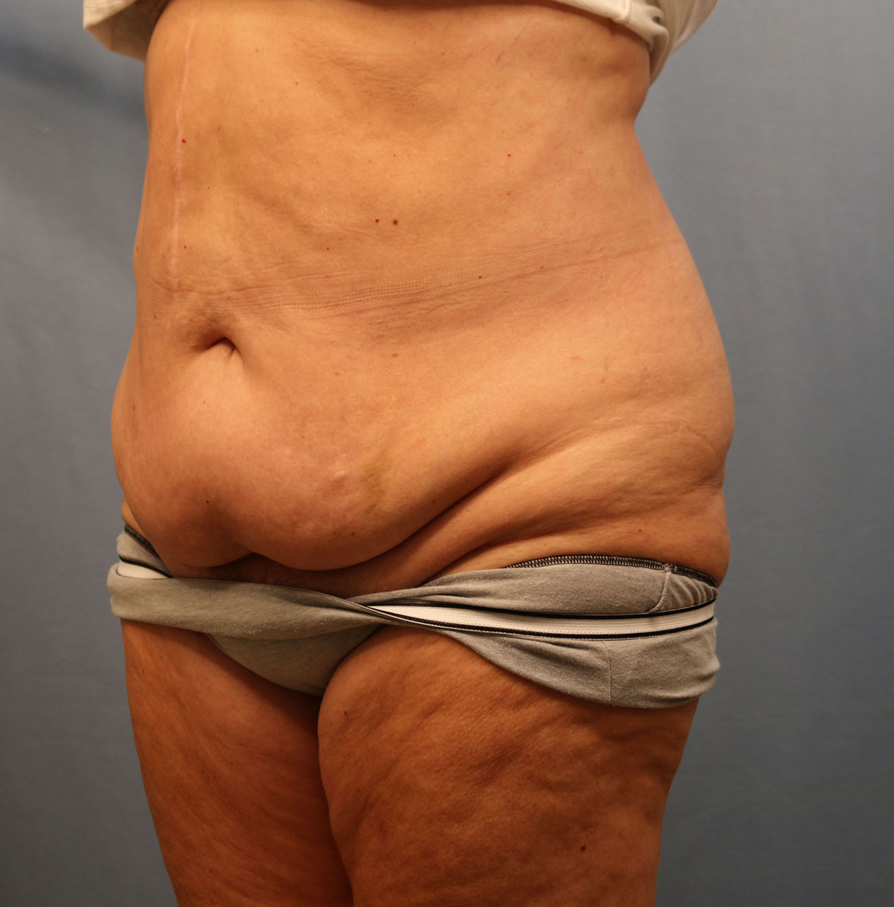 Before Image: Tummy Tuck - left-front-oblique