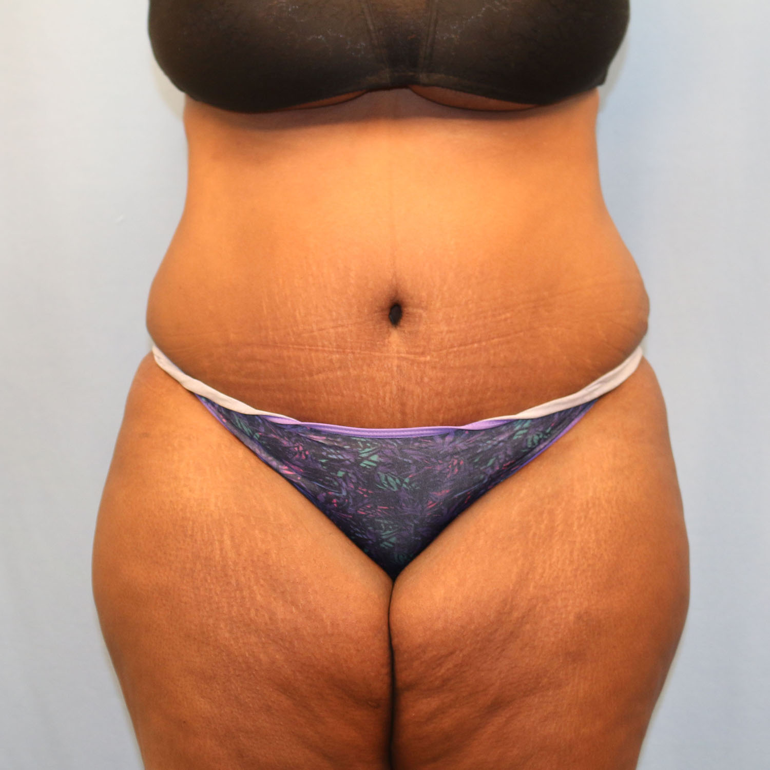 After Image: Tummy Tuck - front