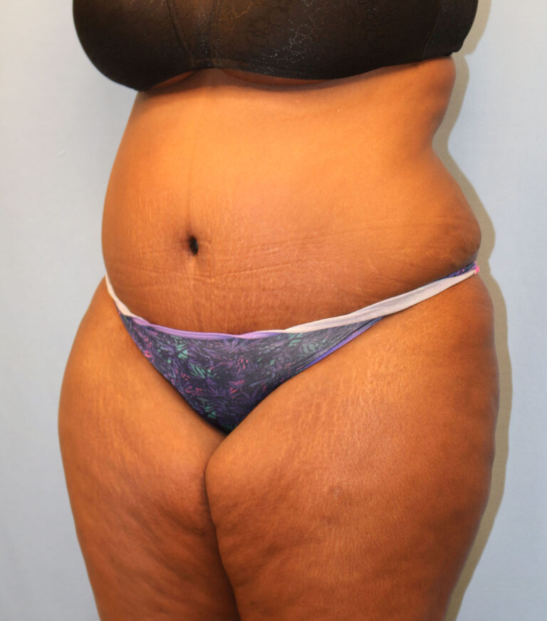 After Image: Tummy Tuck - left-front-oblique