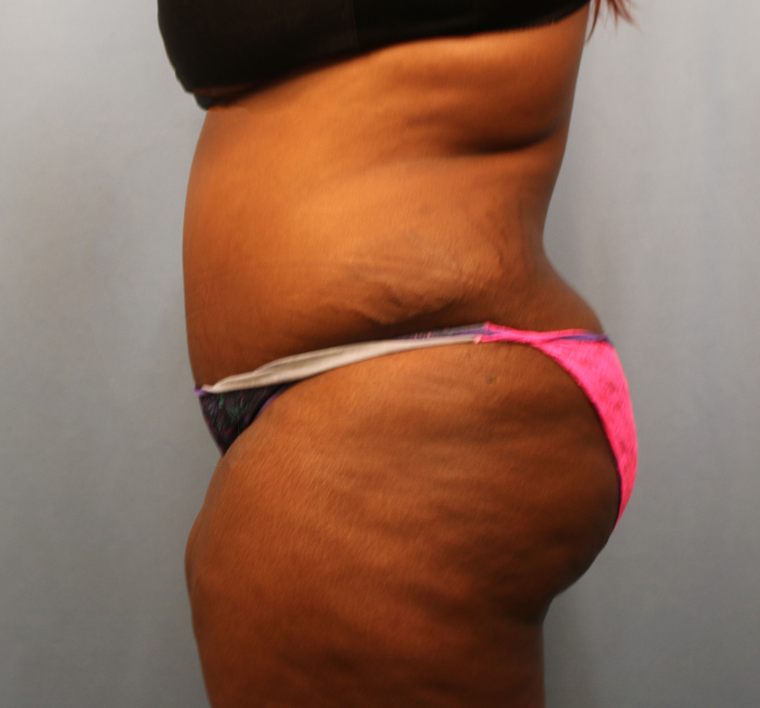After Image: Tummy Tuck - left-side