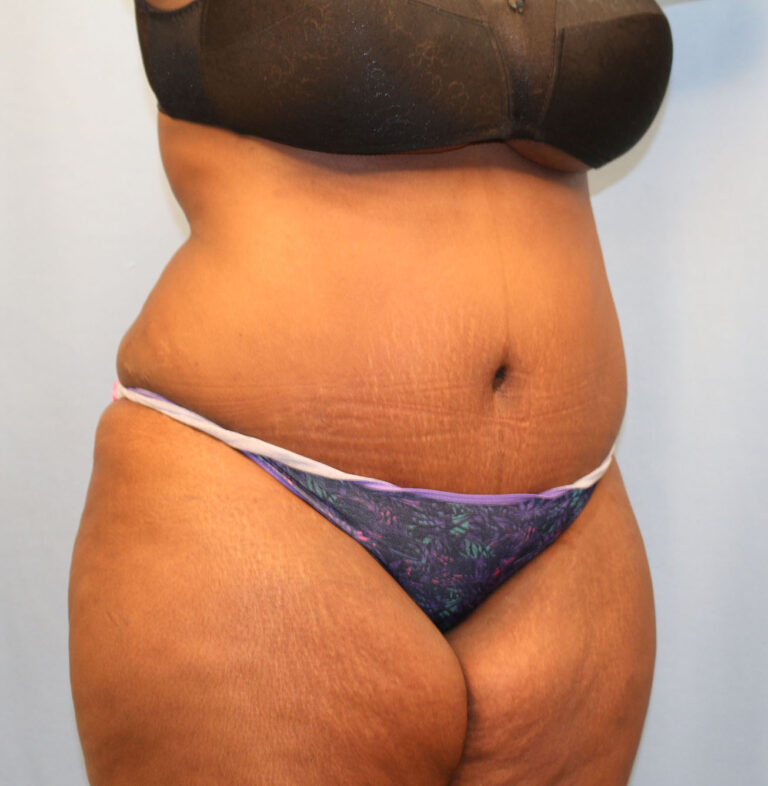 After Image: Tummy Tuck - right-front-oblique