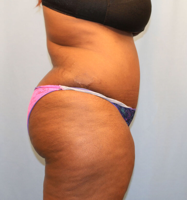 After Image: Tummy Tuck - right-side