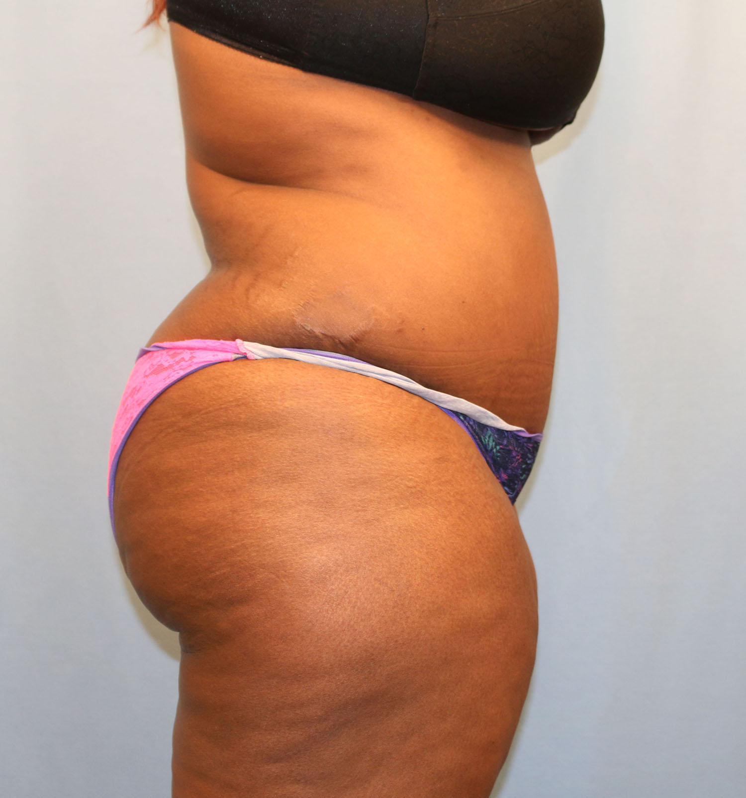 After Image: Tummy Tuck - right-side
