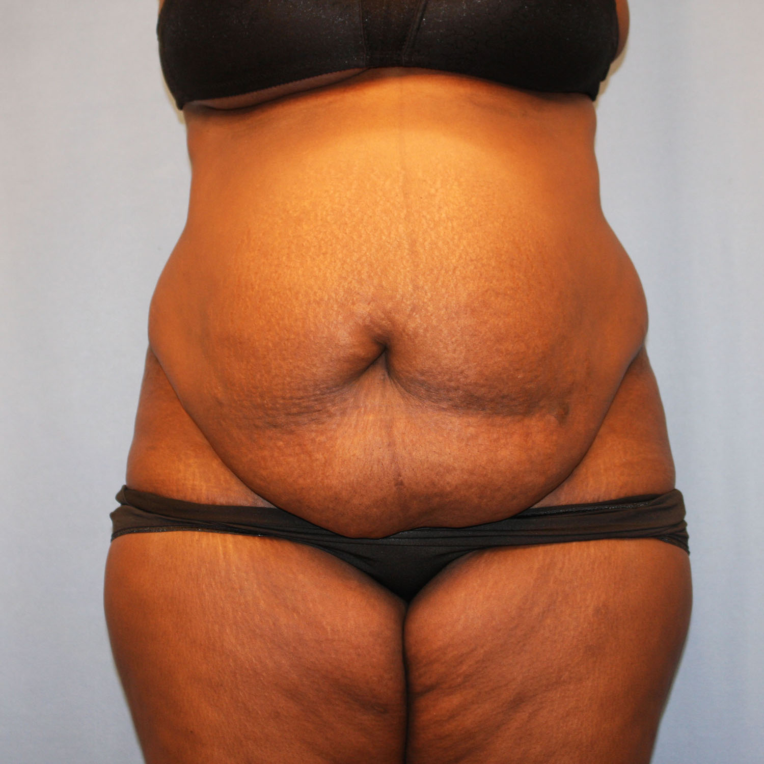 Before Image: Tummy Tuck - front