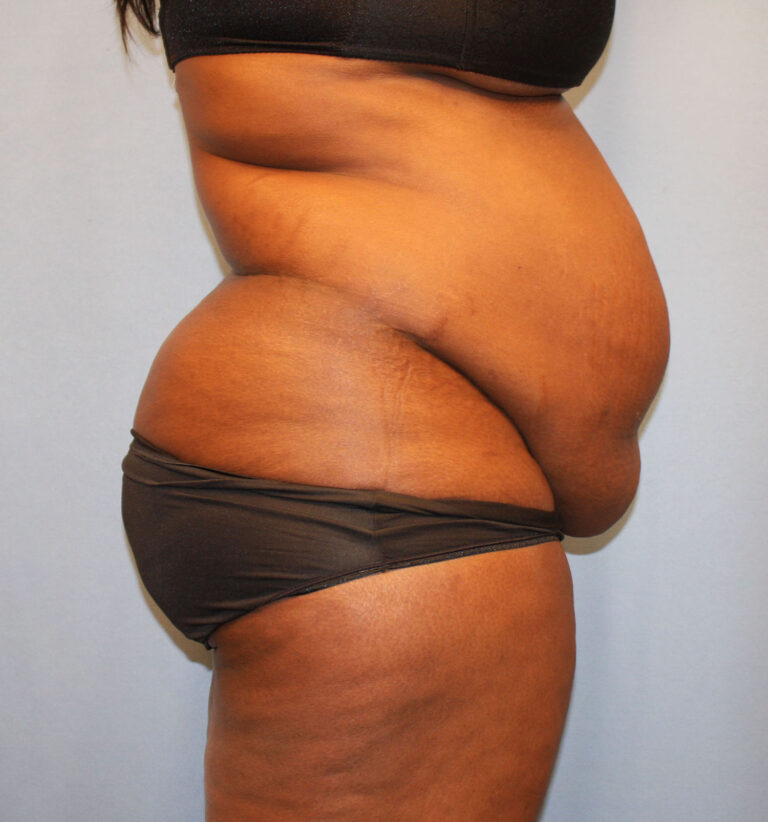 Before Image: Tummy Tuck - right-side