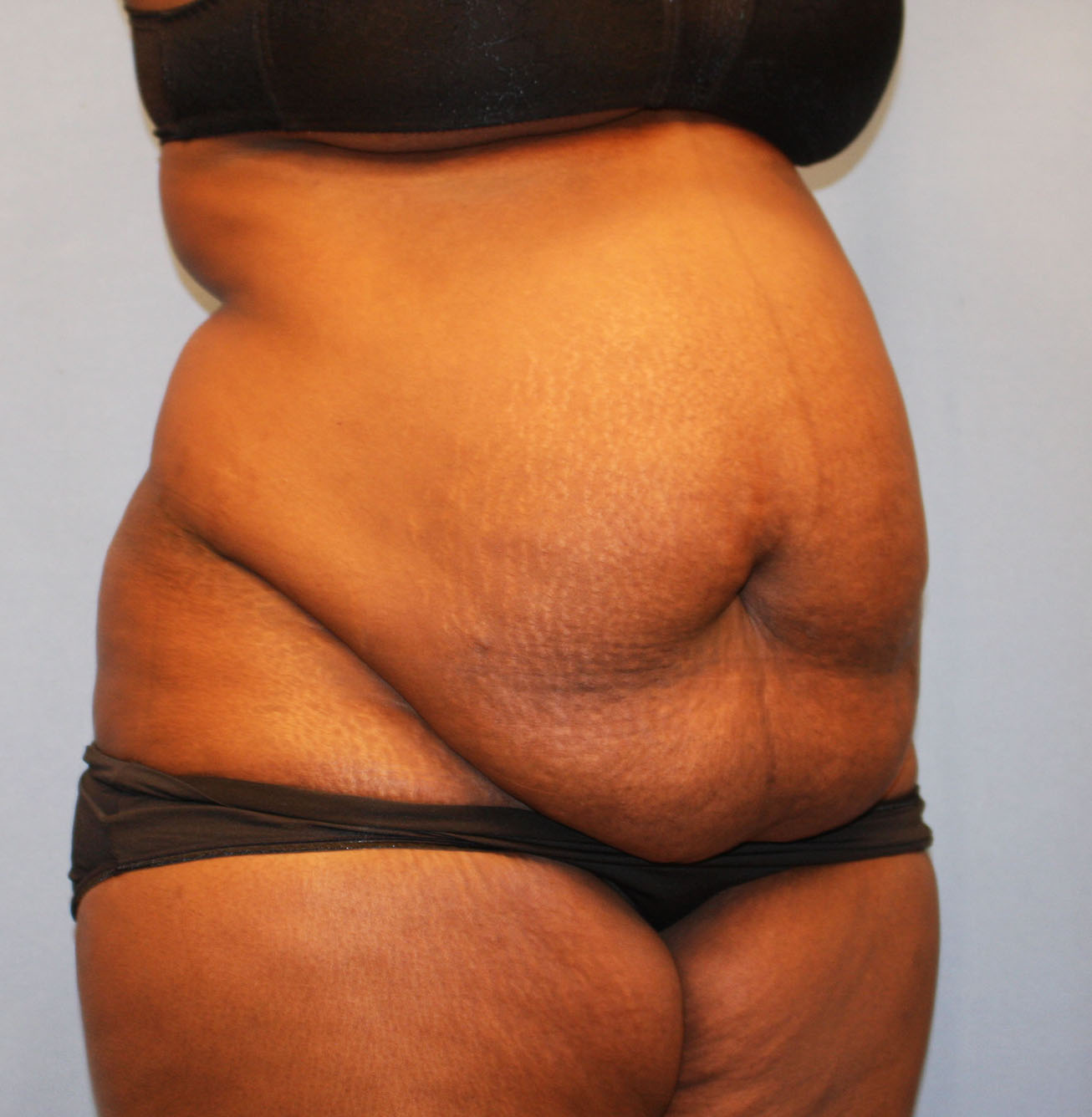 Before Image: Tummy Tuck - right-front-oblique
