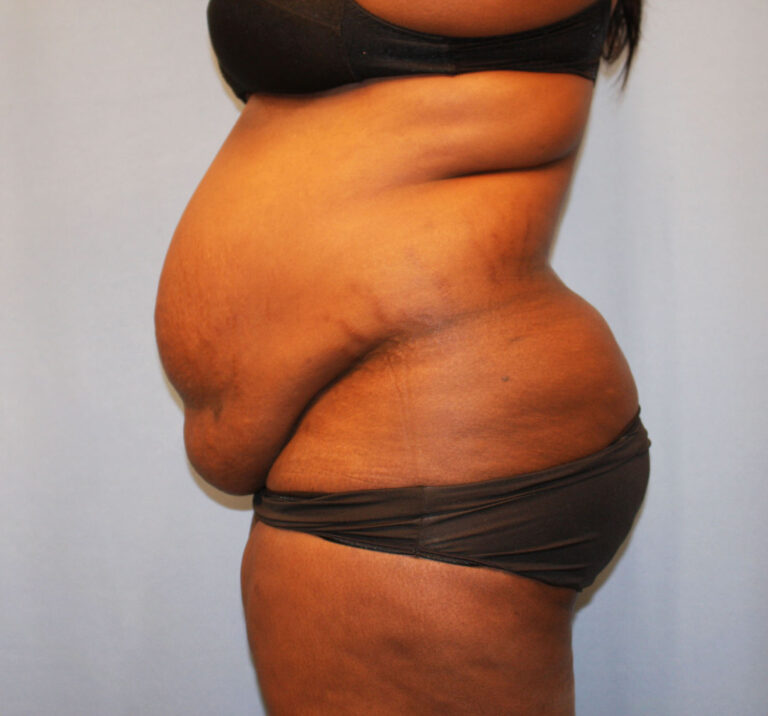 Before Image: Tummy Tuck - left-side