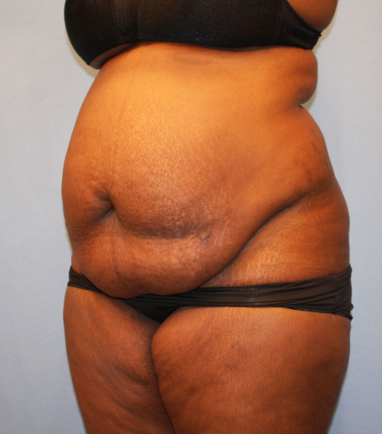 Before Image: Tummy Tuck - left-front-oblique