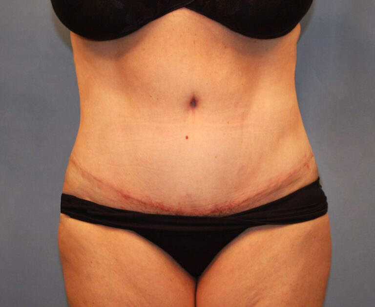 After Image: Tummy Tuck - front