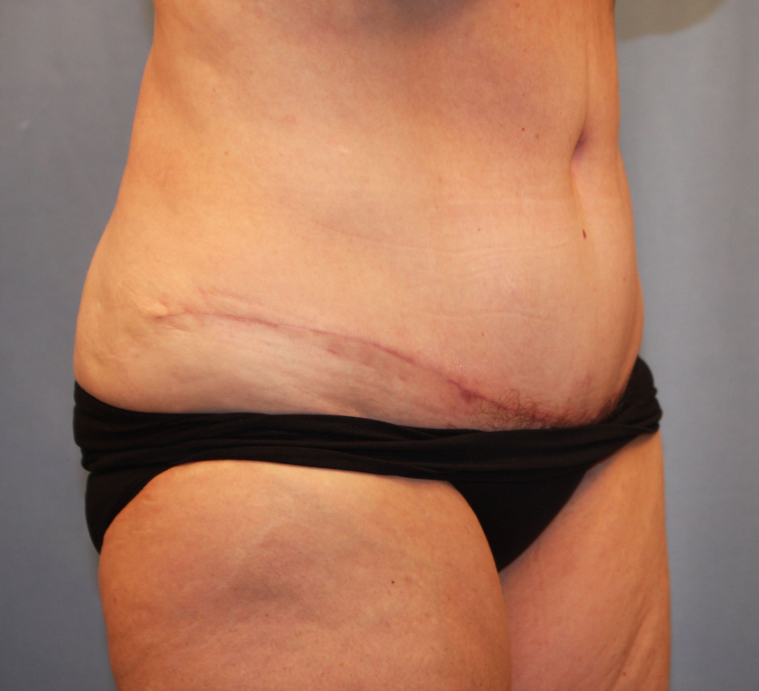 After Image: Tummy Tuck - right-front-oblique