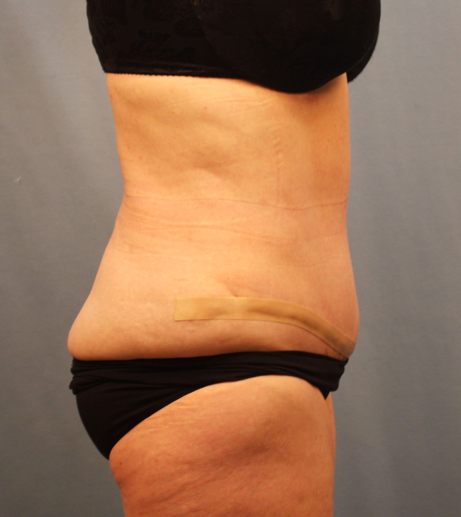 After Image: Tummy Tuck - right-side