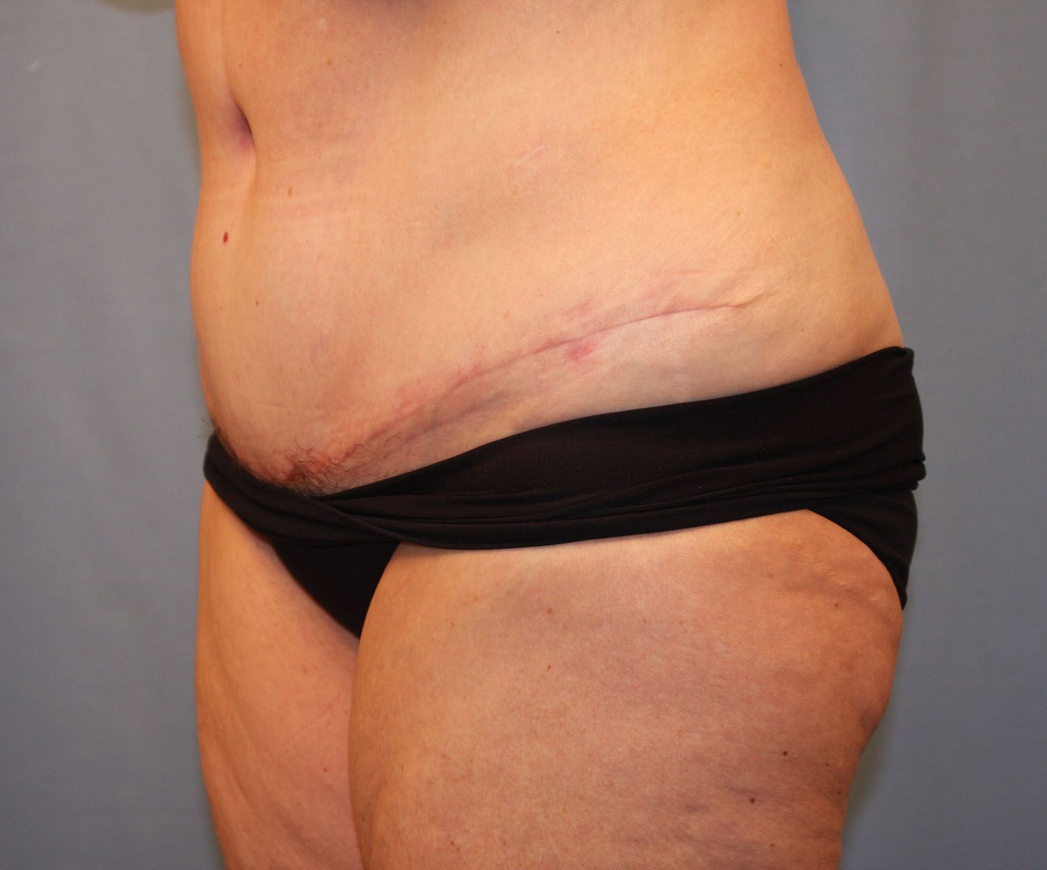 After Image: Tummy Tuck - left-front-oblique