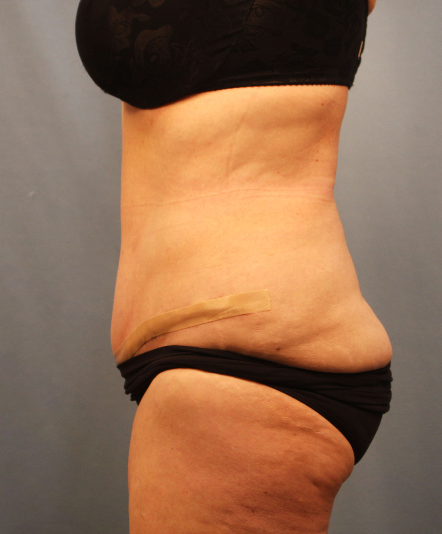 After Image: Tummy Tuck - left-side
