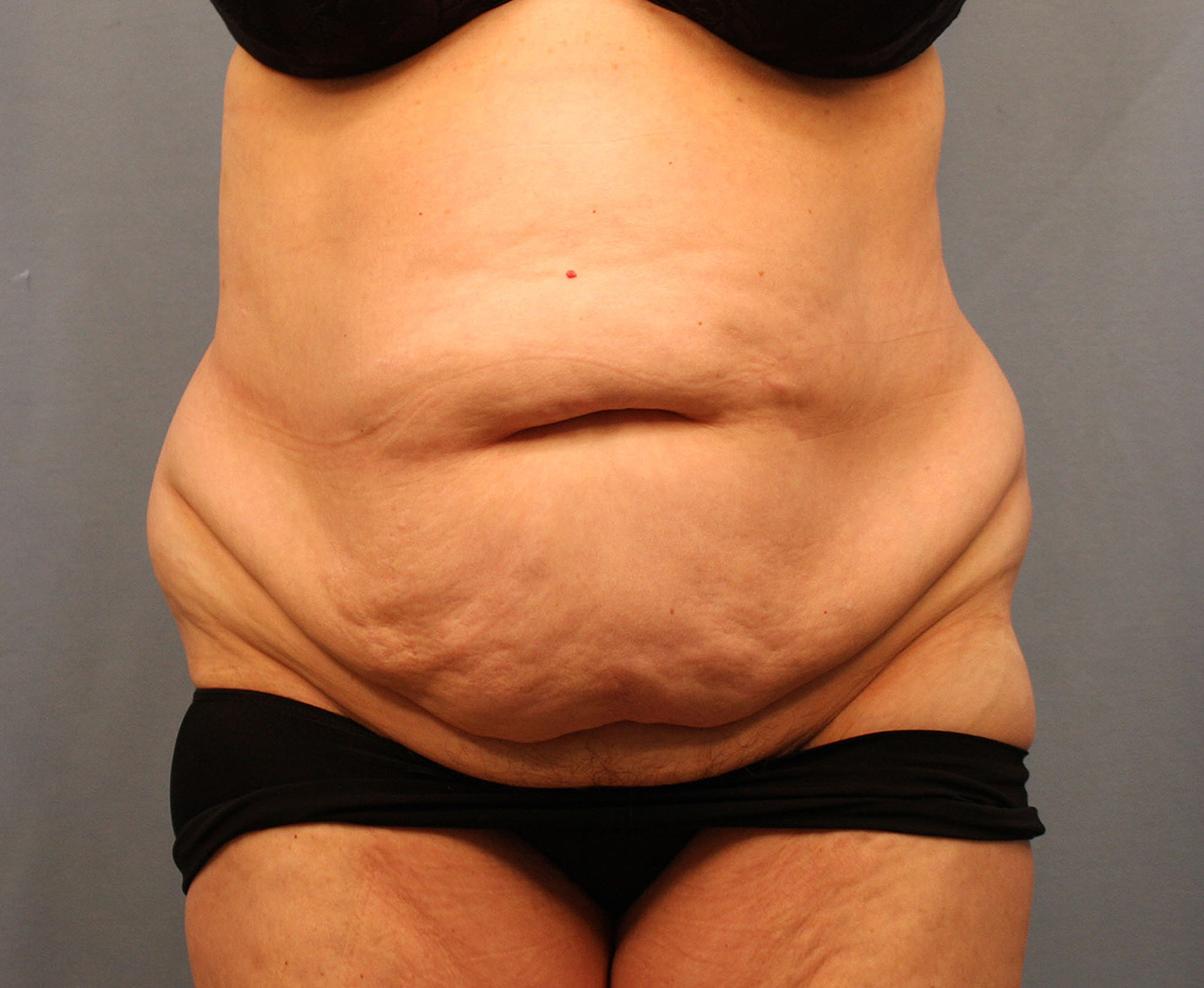 Before Image: Tummy Tuck - front