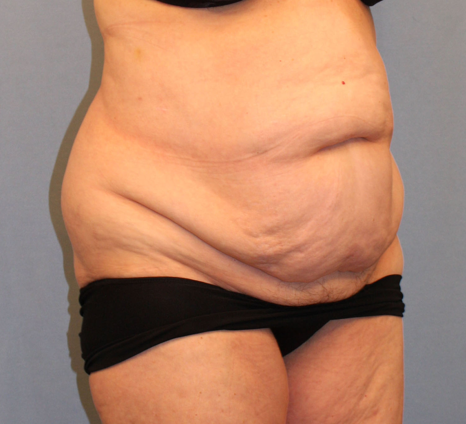 Before Image: Tummy Tuck - right-front-oblique