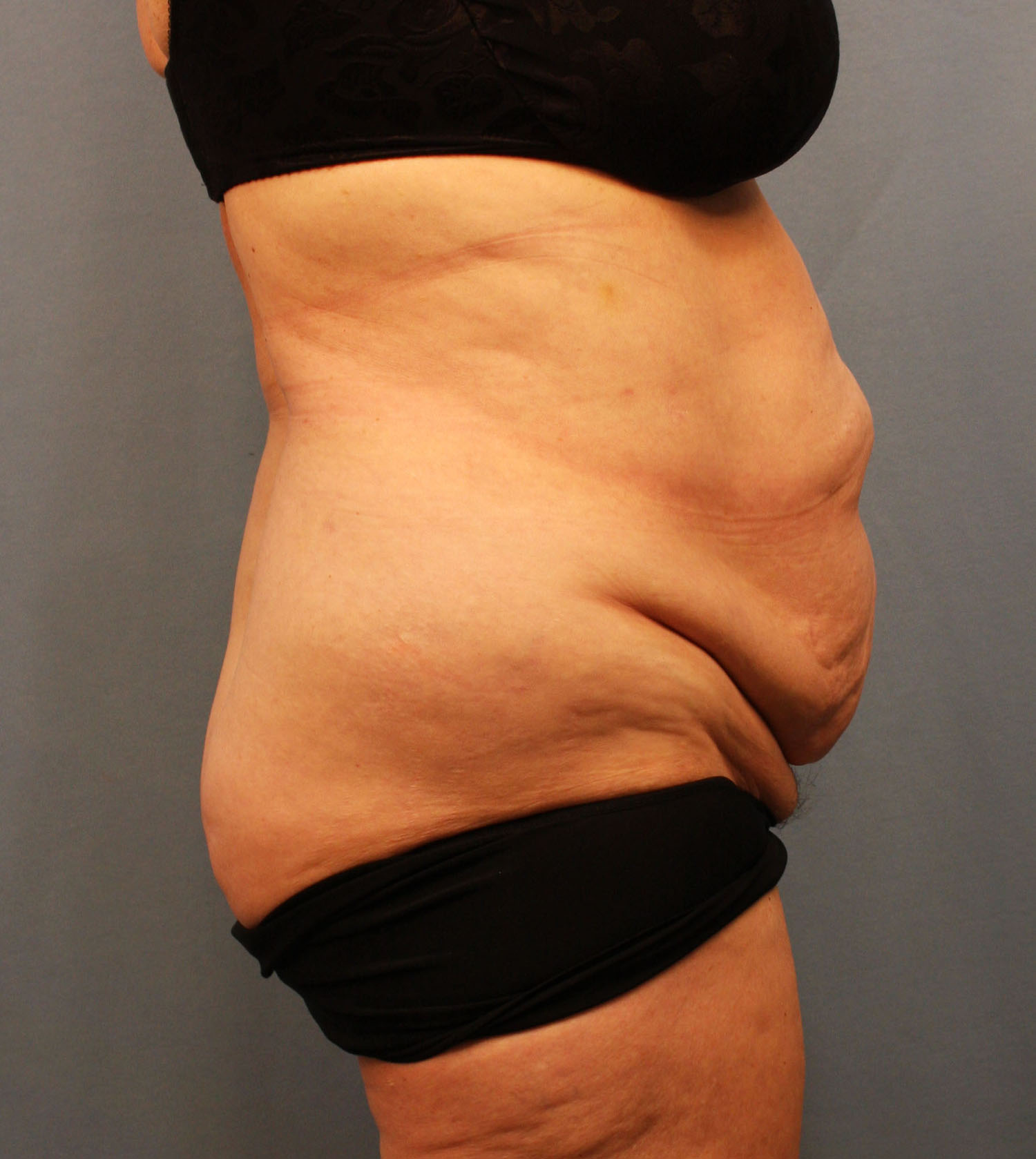 Before Image: Tummy Tuck - right-side