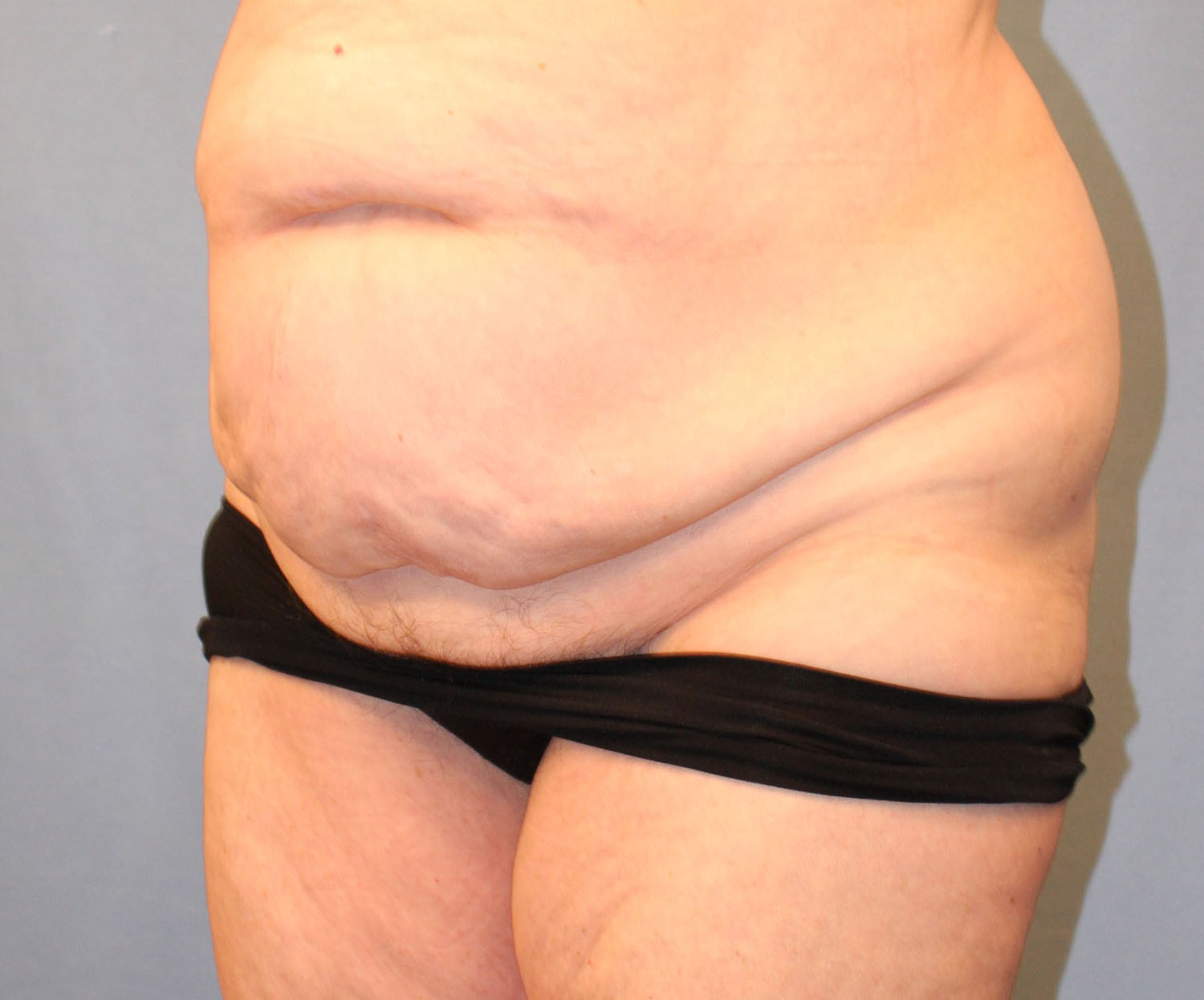 Before Image: Tummy Tuck - left-front-oblique