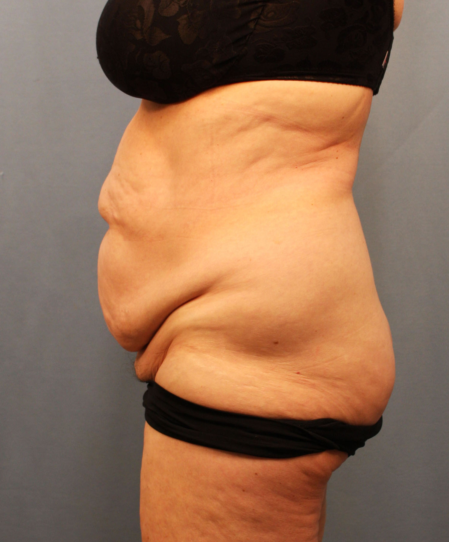 Before Image: Tummy Tuck - left-side