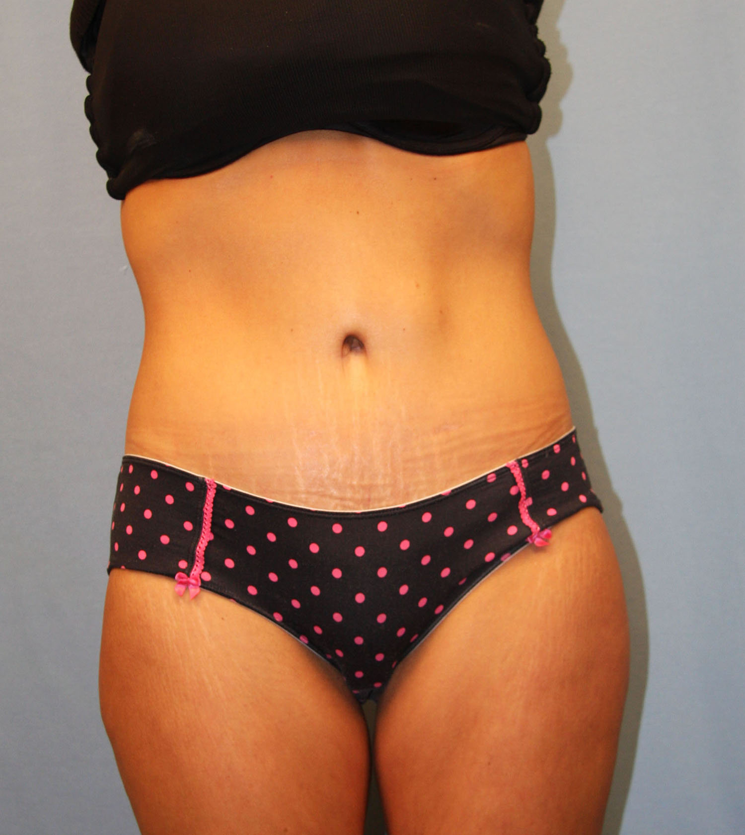 After Image: Tummy Tuck - front
