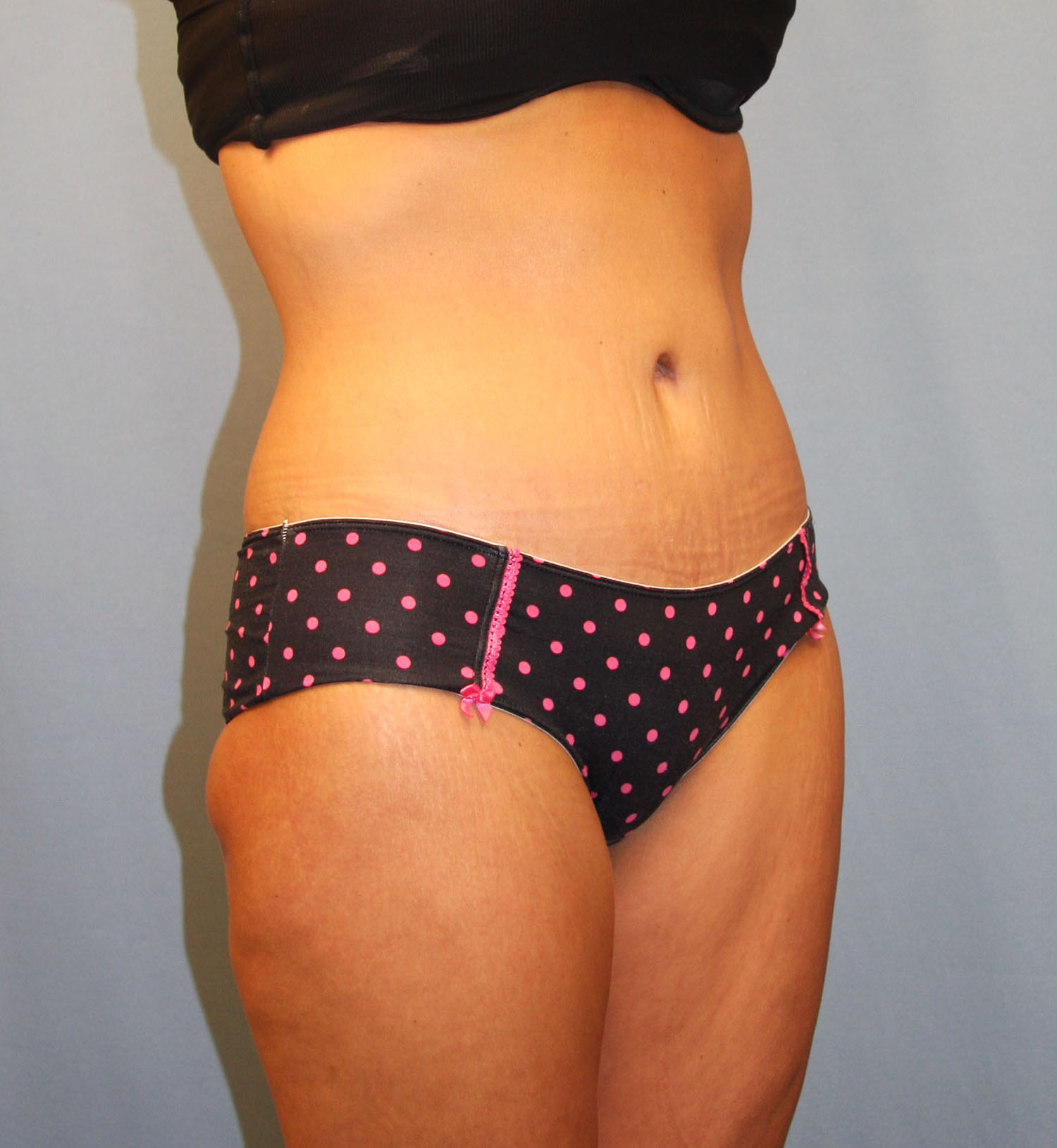 After Image: Tummy Tuck - right-front-oblique