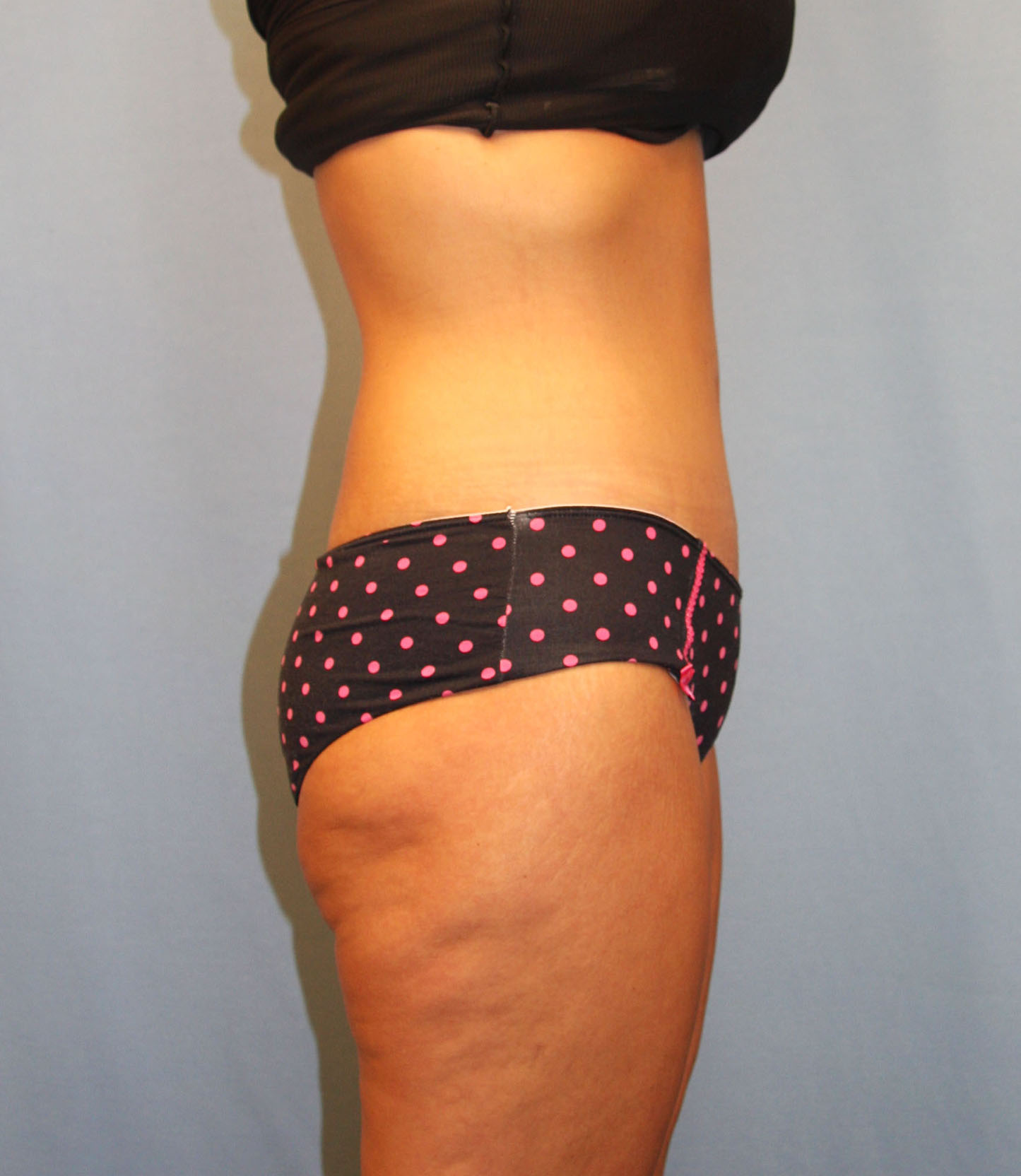 After Image: Tummy Tuck - right-side
