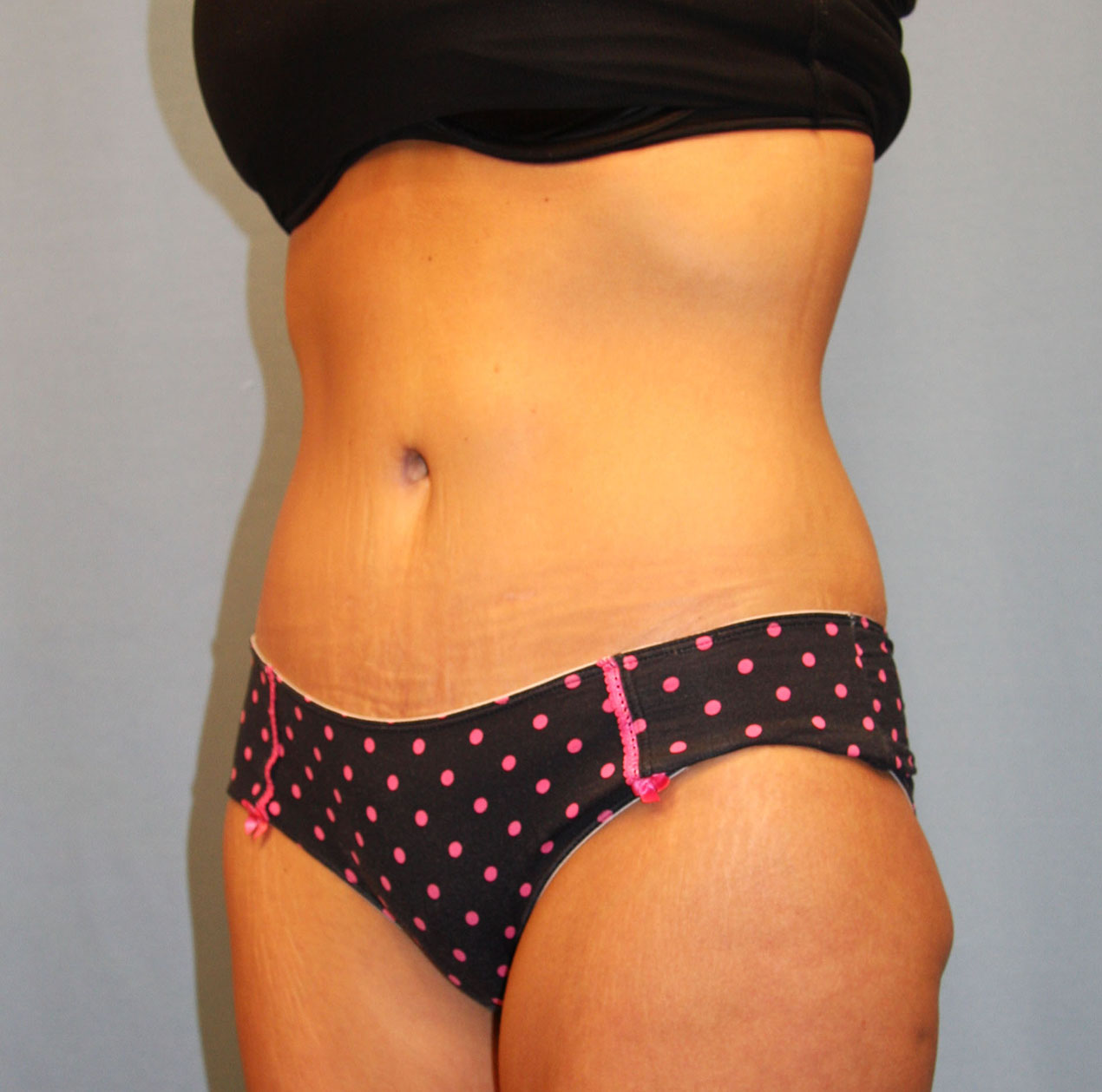 After Image: Tummy Tuck - left-front-oblique