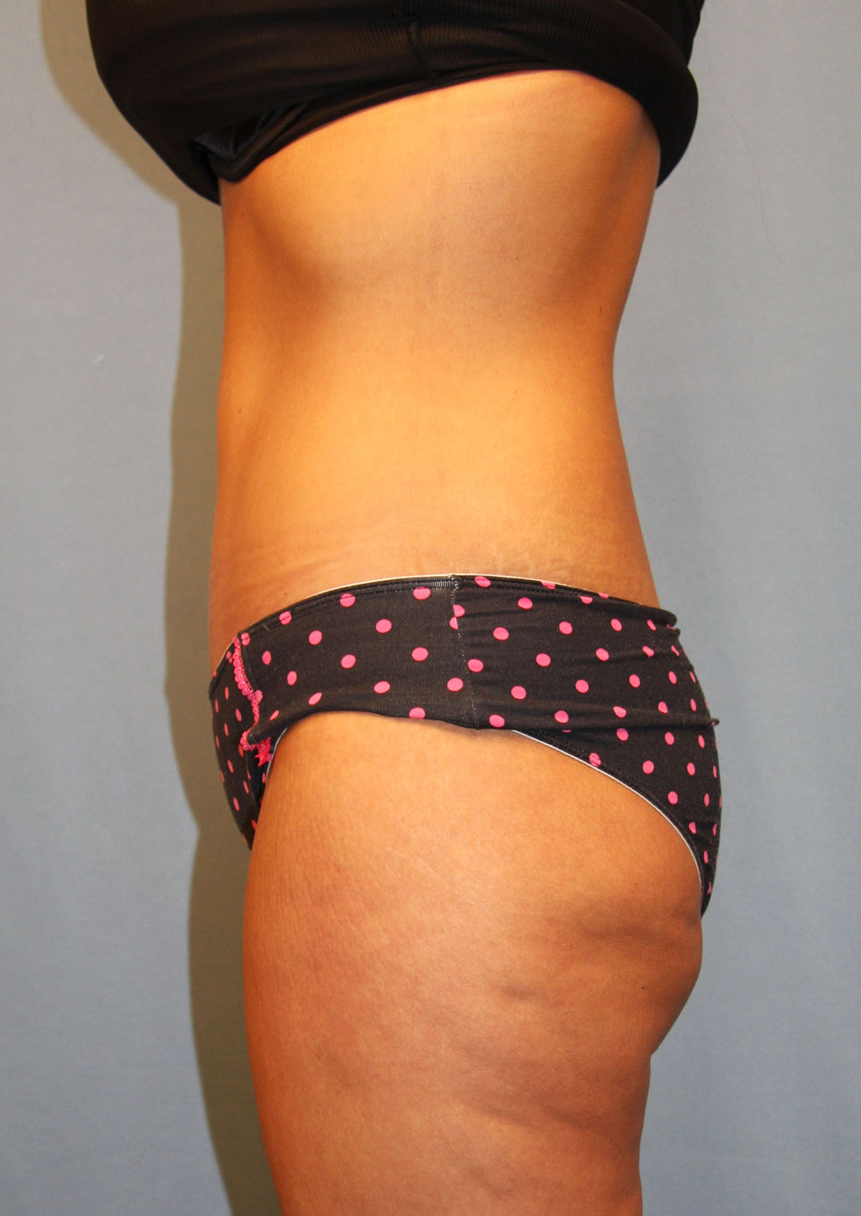 After Image: Tummy Tuck - left-side