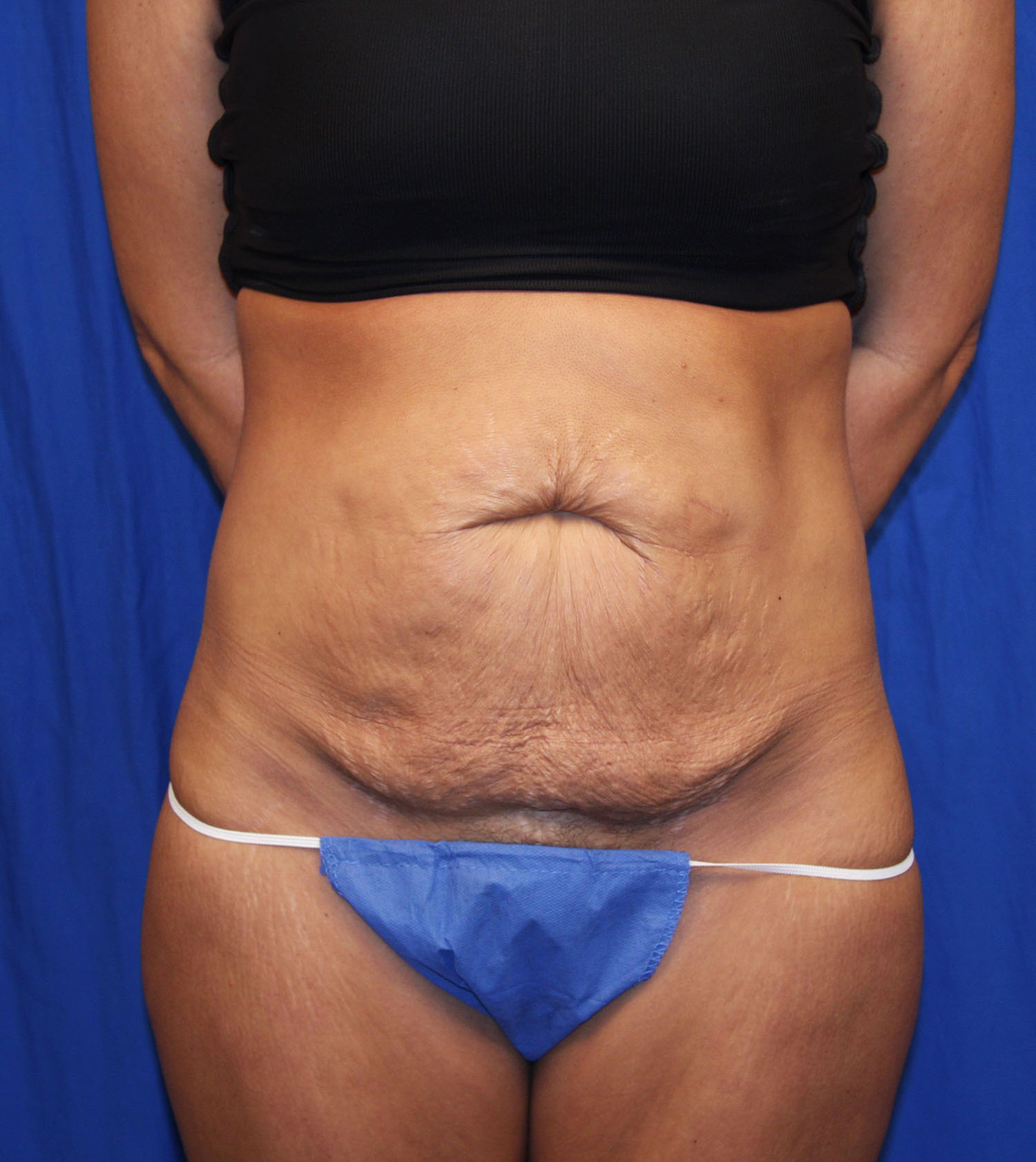 Before Image: Tummy Tuck - front