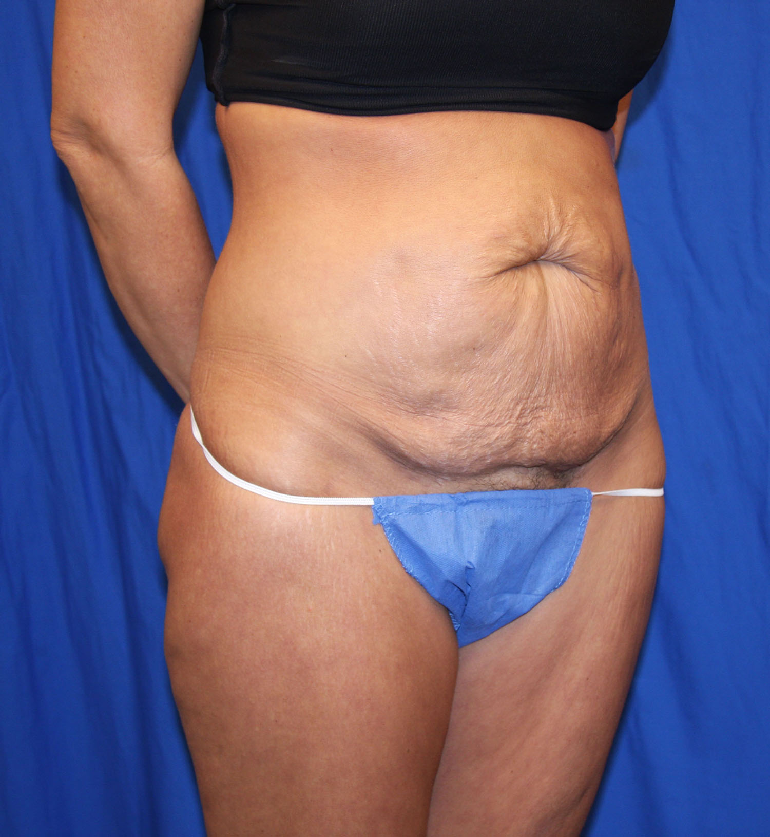 Before Image: Tummy Tuck - right-front-oblique