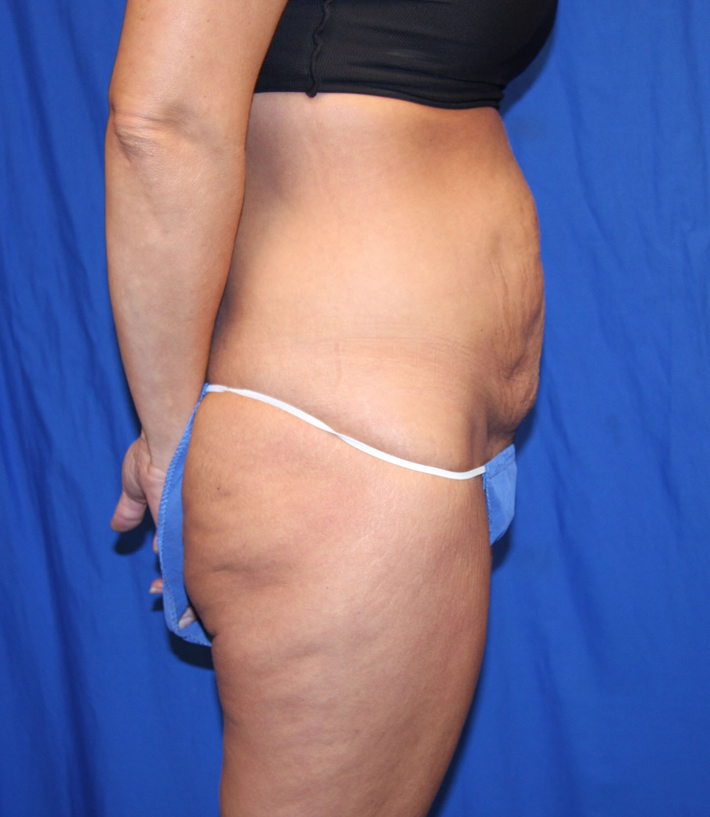 Before Image: Tummy Tuck - right-side