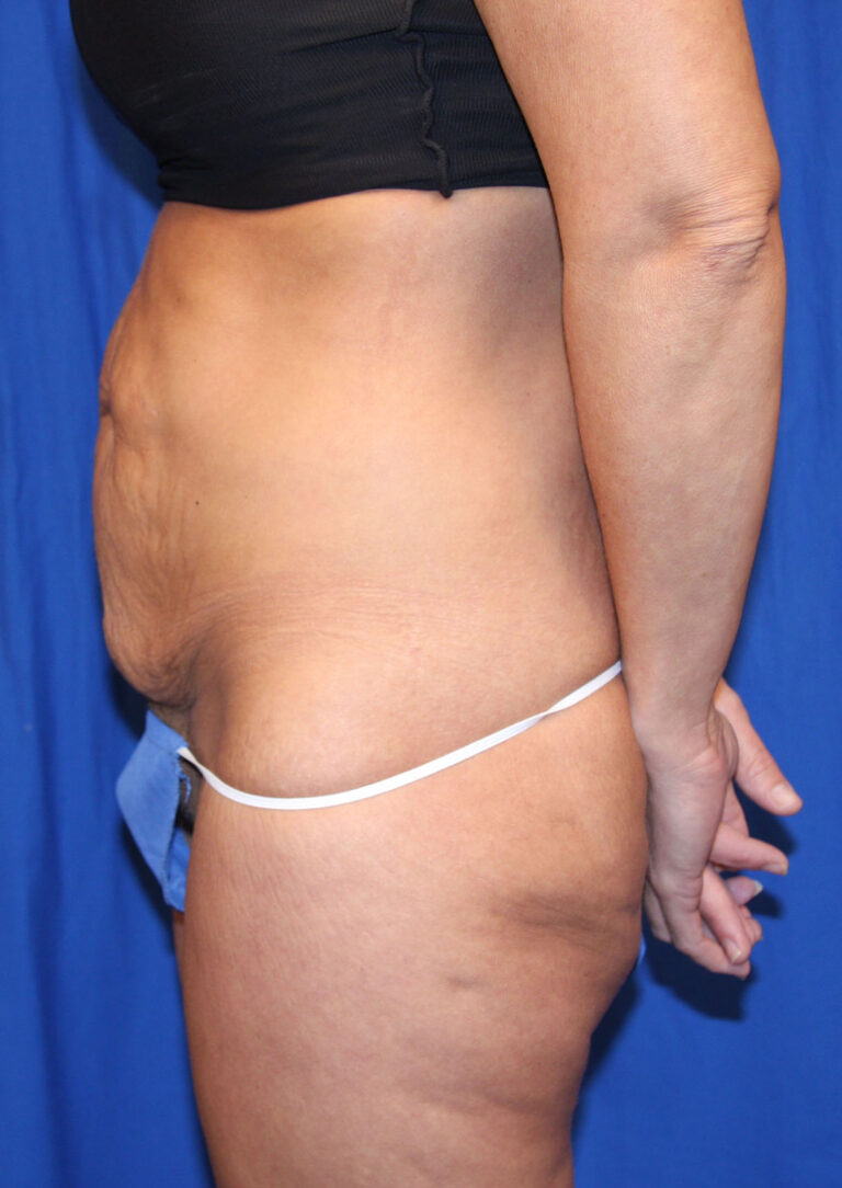 Before Image: Tummy Tuck - left-side