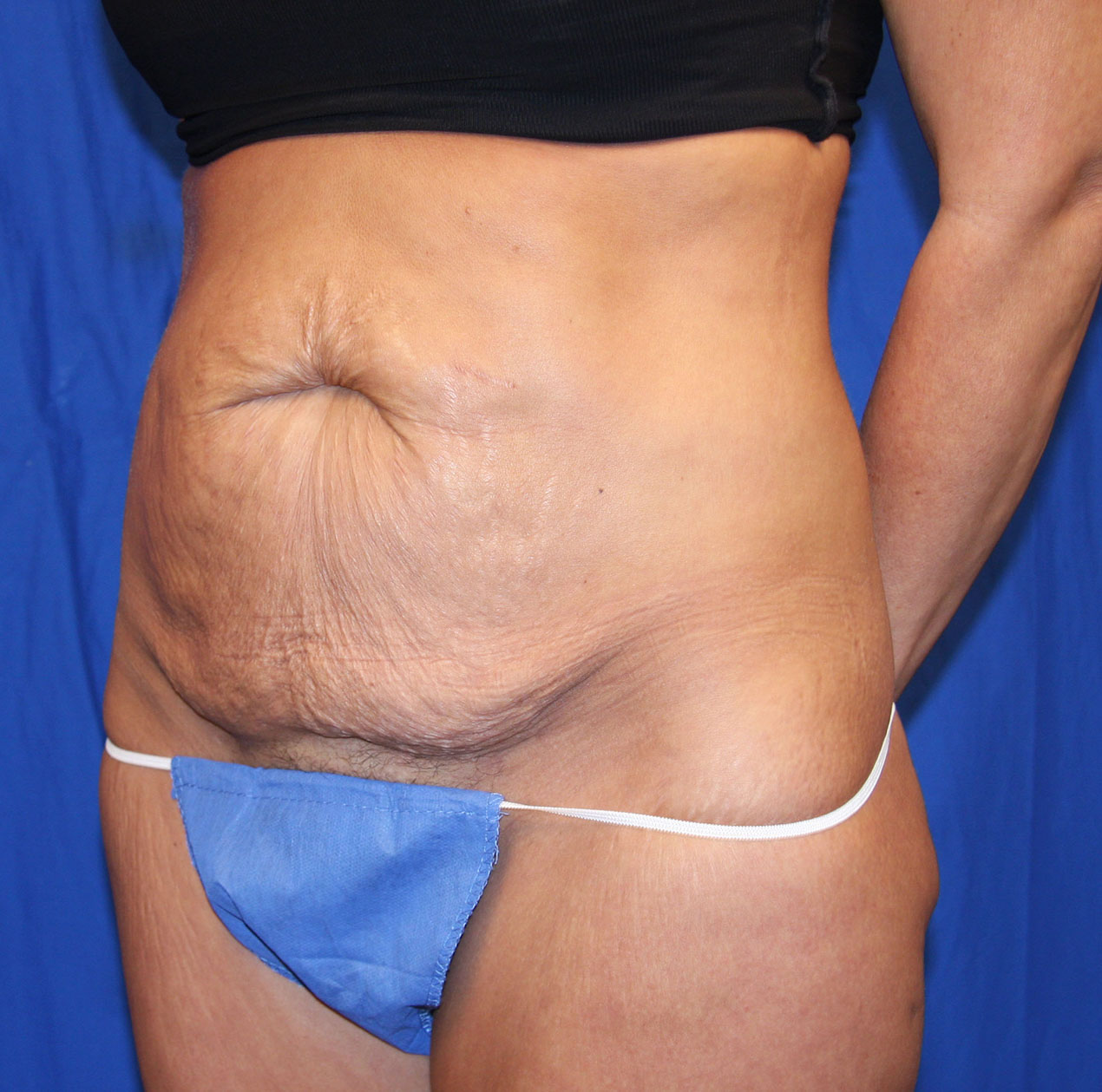 Before Image: Tummy Tuck - left-front-oblique