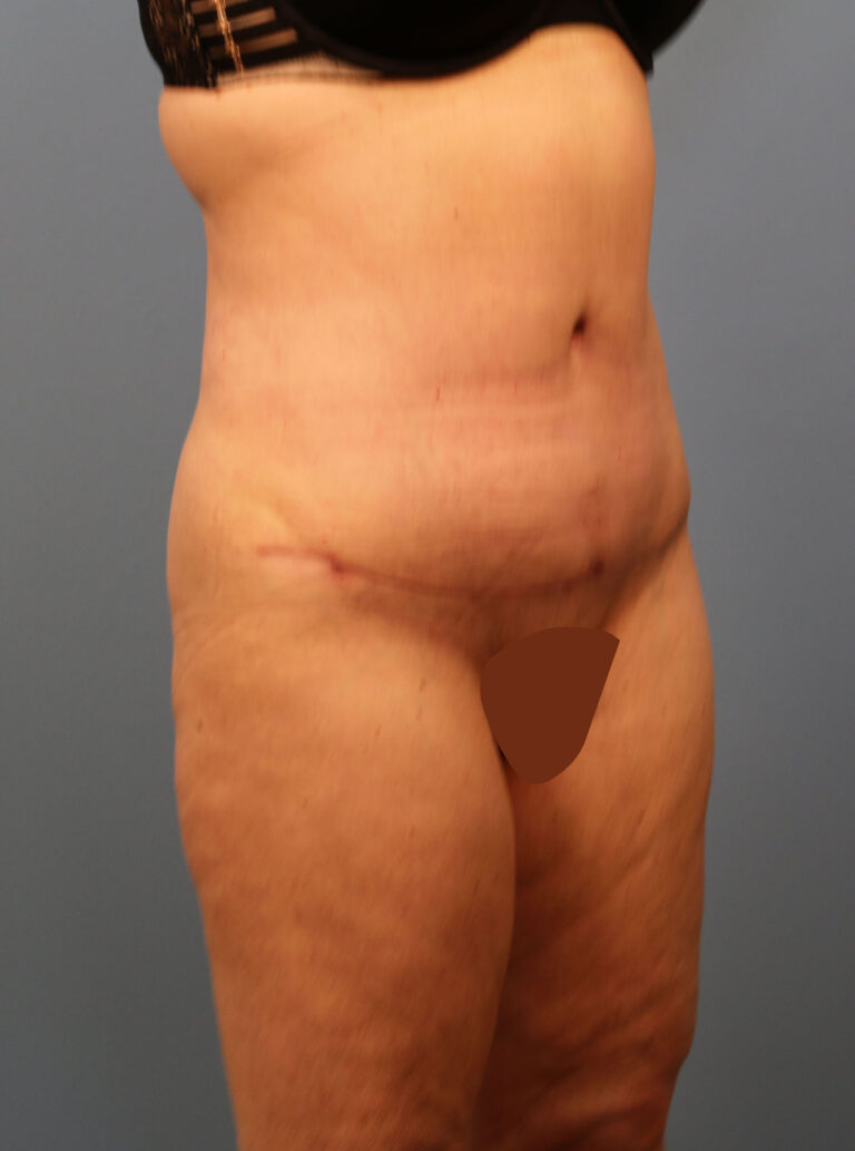 After Image: Tummy Tuck - right-front-oblique