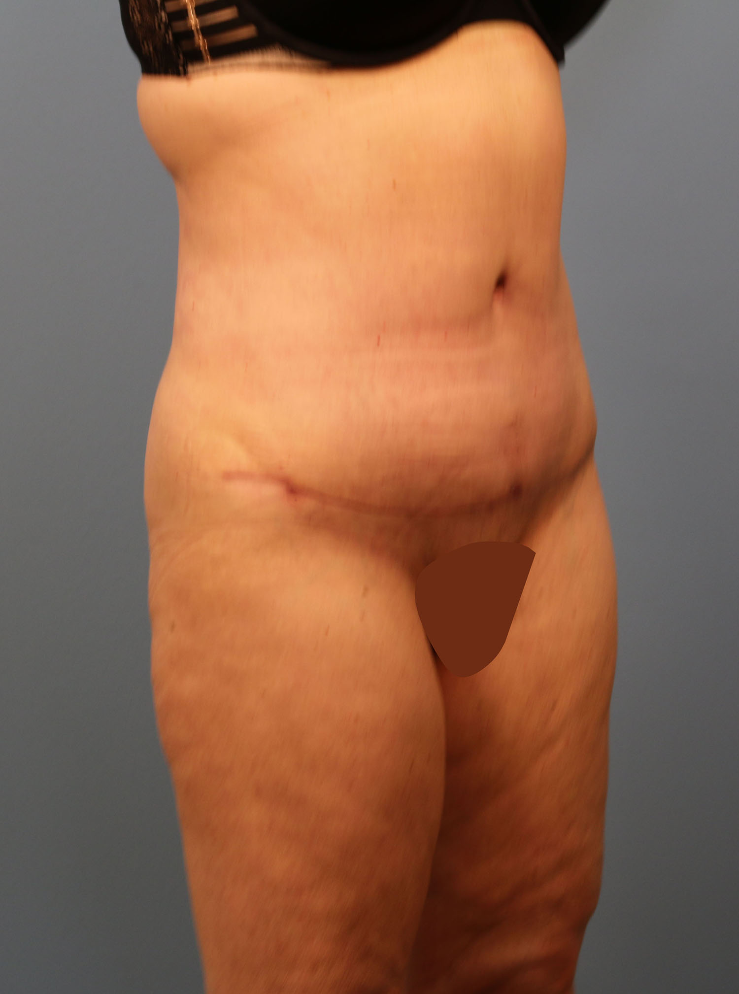 After Image: Tummy Tuck - right-front-oblique