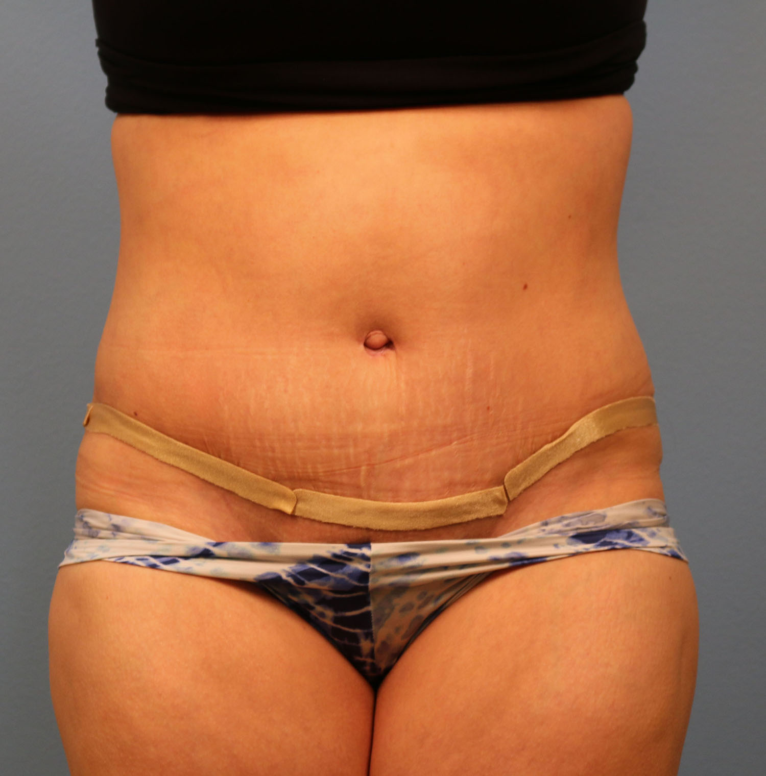 After Image: Tummy Tuck - front