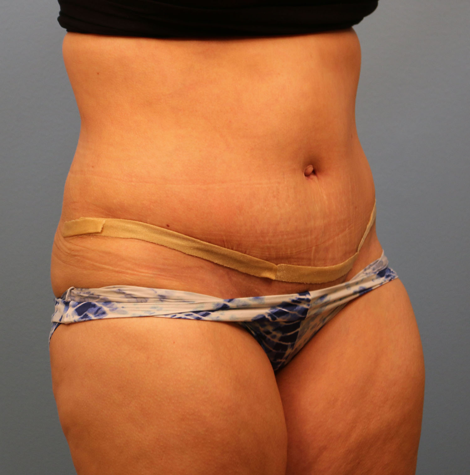 After Image: Tummy Tuck - right-front-oblique