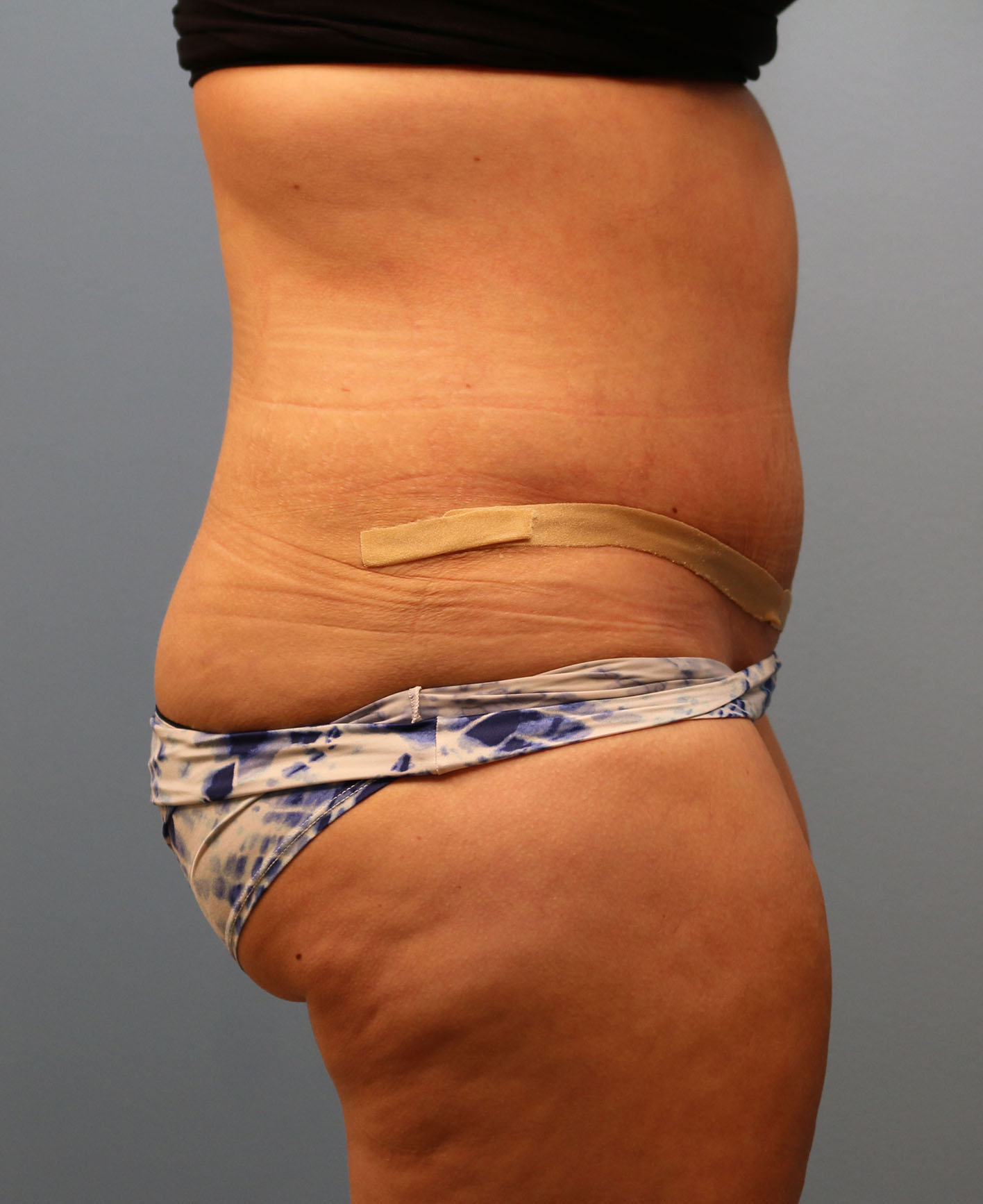 After Image: Tummy Tuck - right-side
