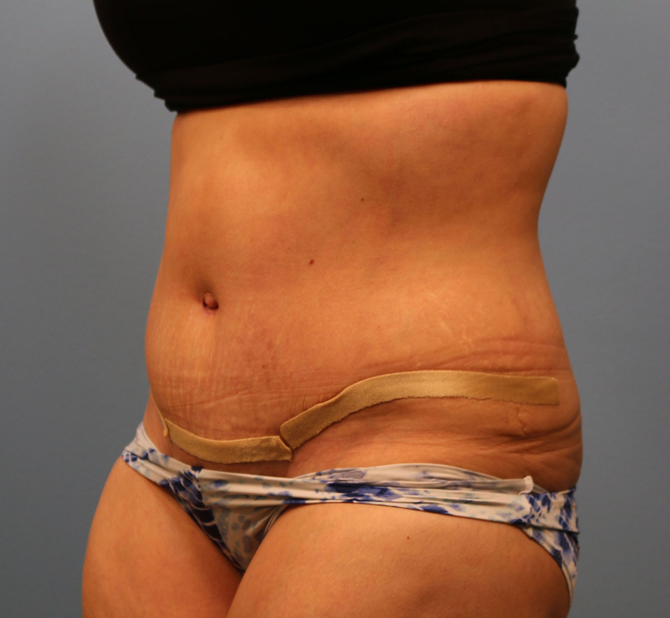 After Image: Tummy Tuck - left-front-oblique