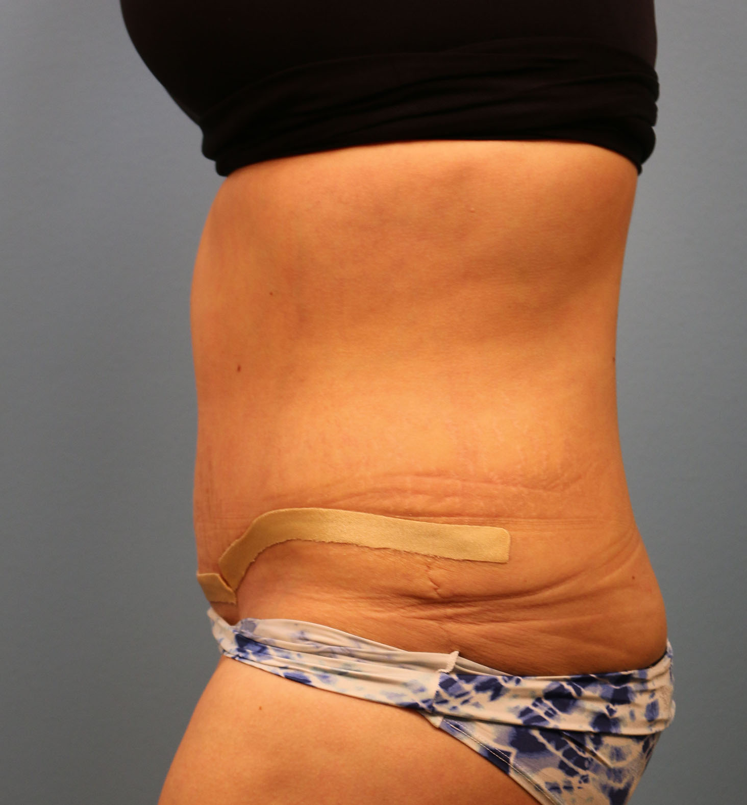 After Image: Tummy Tuck - left-side