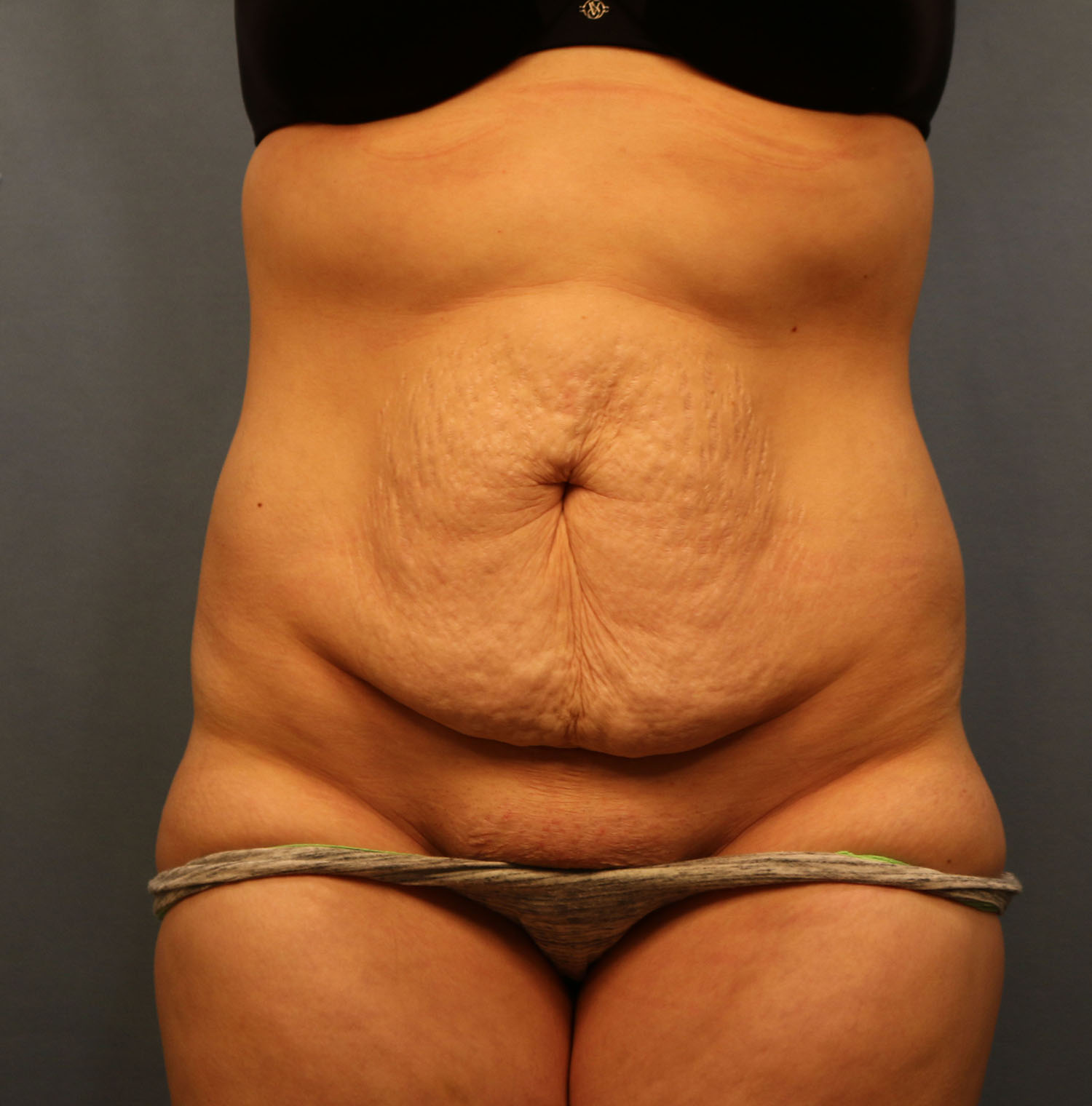 Before Image: Tummy Tuck - front