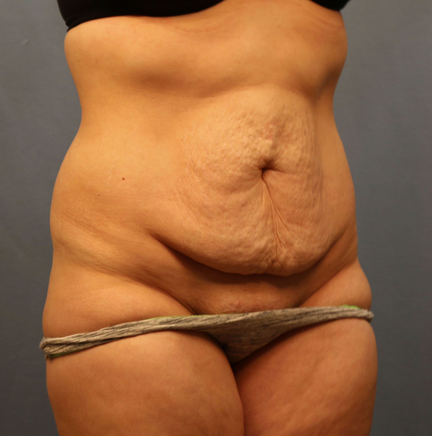Before Image: Tummy Tuck - right-front-oblique
