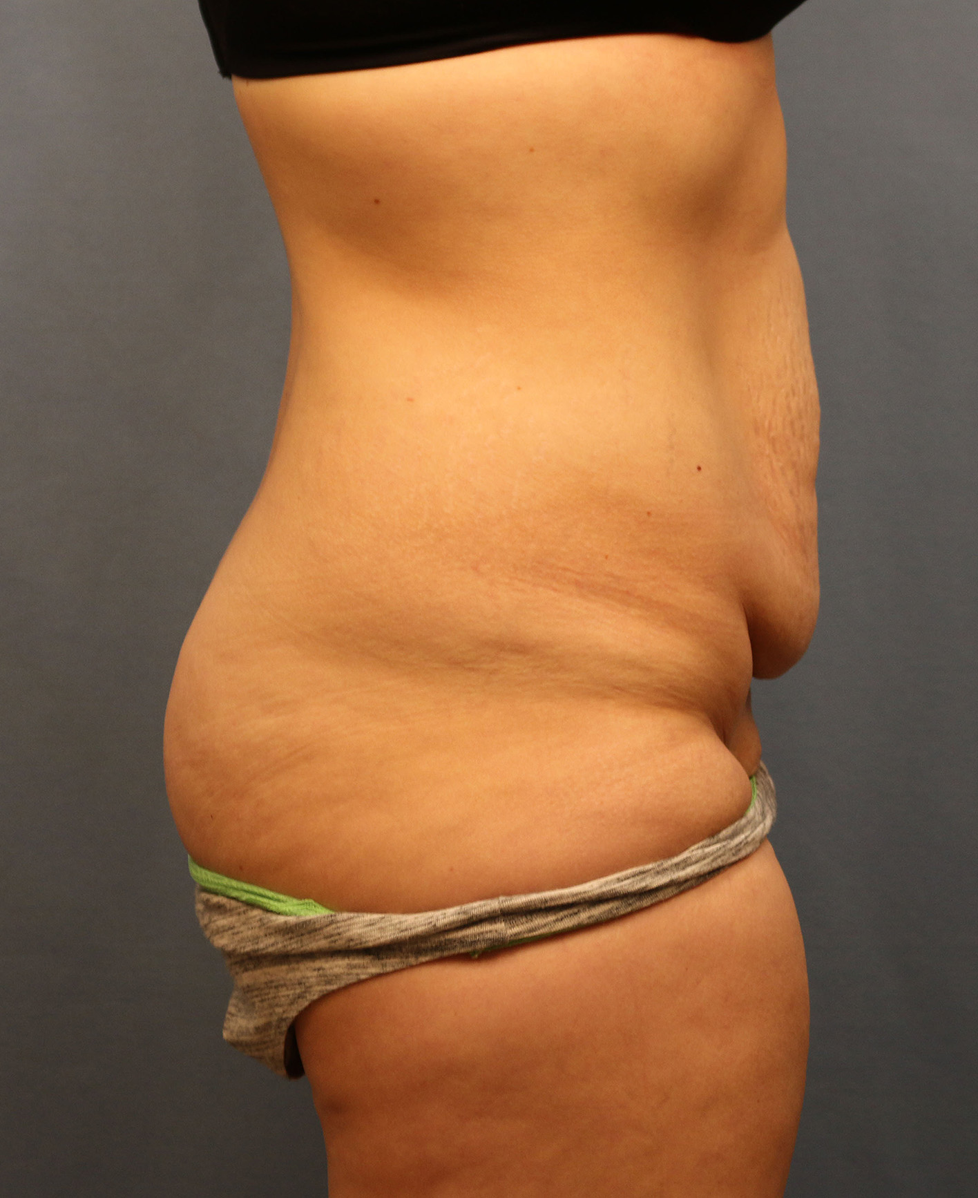 Before Image: Tummy Tuck - right-side