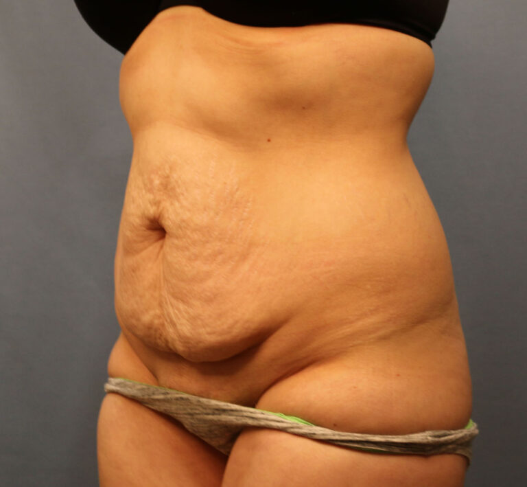 Before Image: Tummy Tuck - left-front-oblique