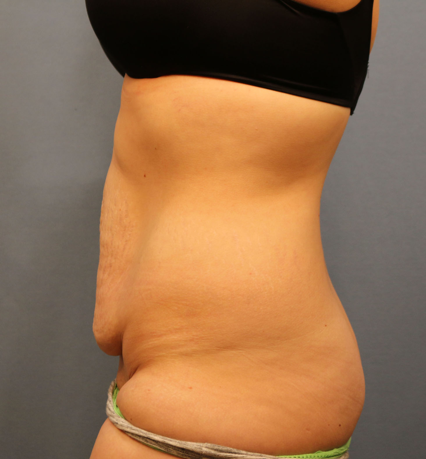 Before Image: Tummy Tuck - left-side