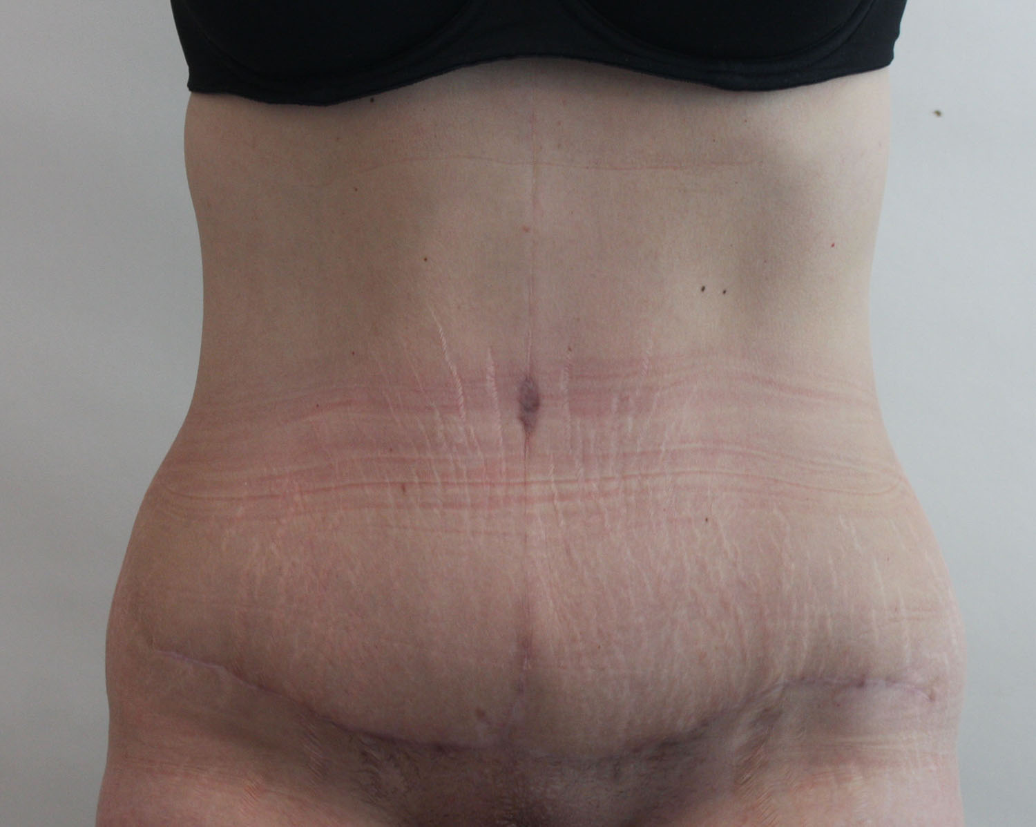 After Image: Tummy Tuck - front