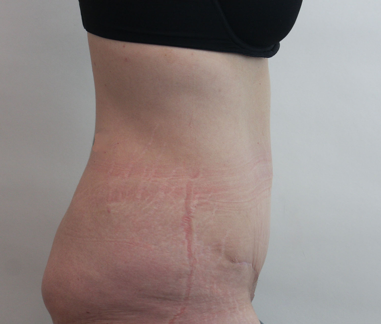 After Image: Tummy Tuck - right-side