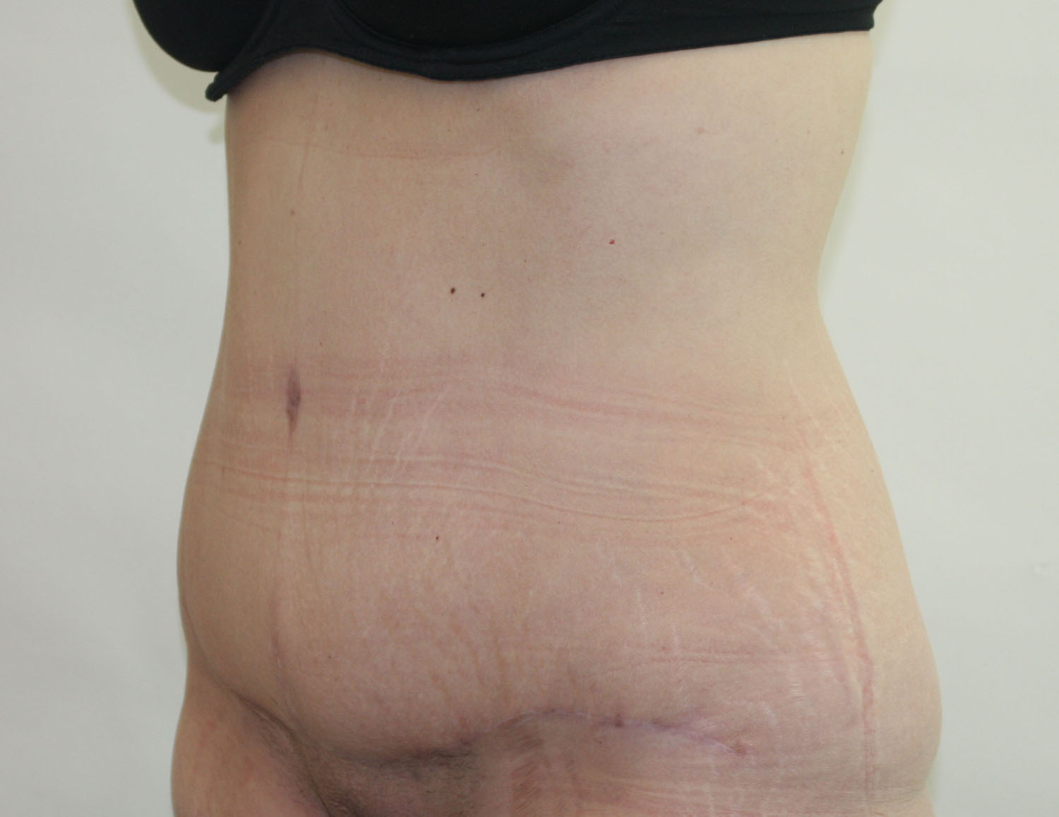 After Image: Tummy Tuck - left-front-oblique