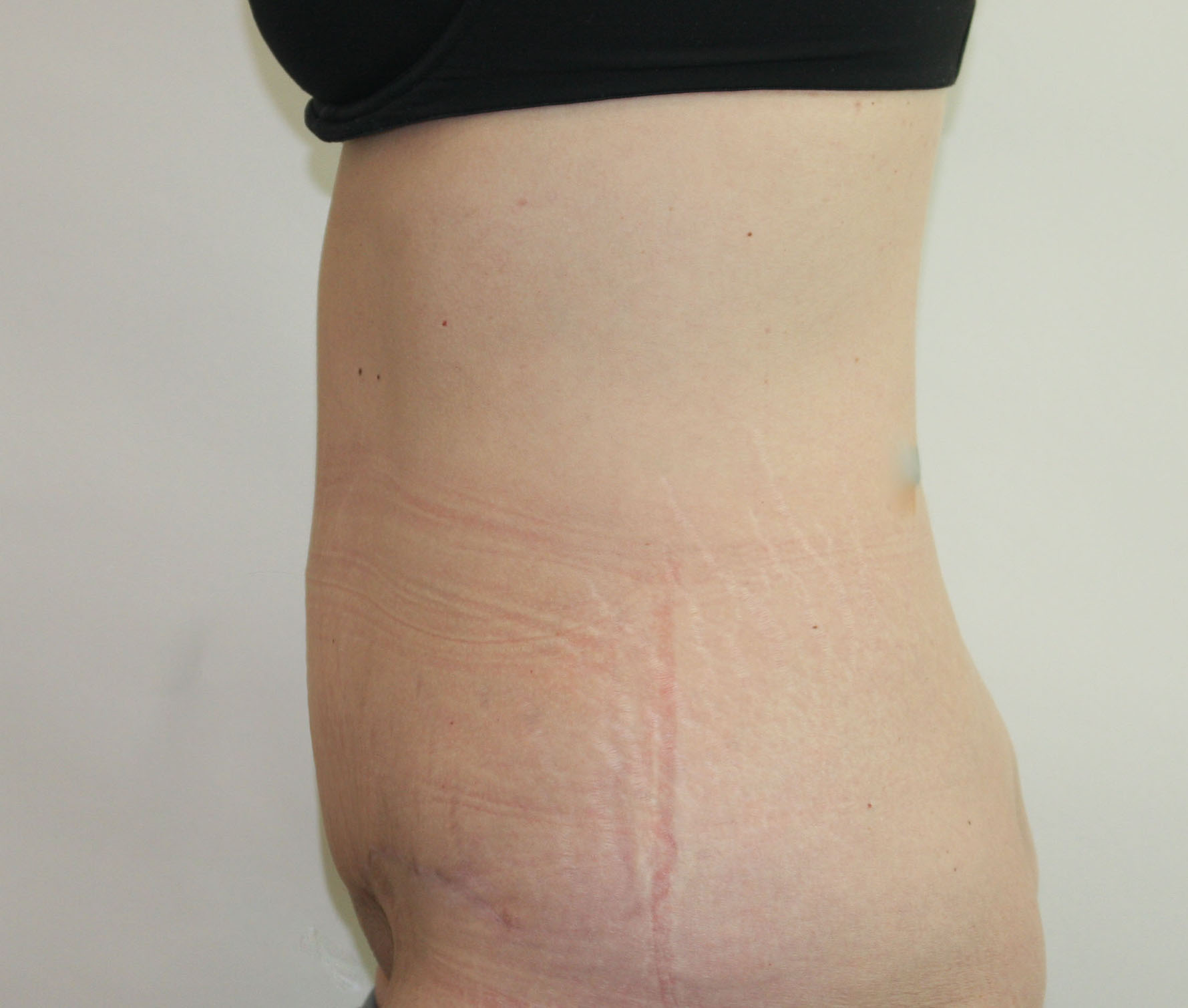 After Image: Tummy Tuck - left-side