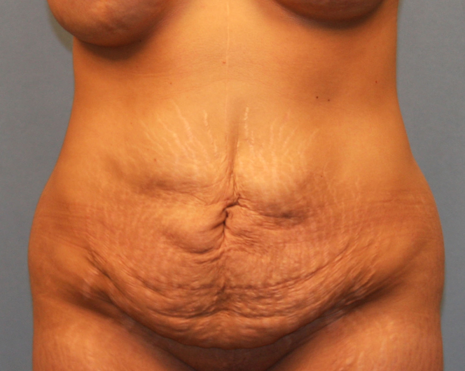 Before Image: Tummy Tuck - front